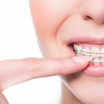 如何發現咬合不正症狀以及在箍牙治療期間使用什麼器具